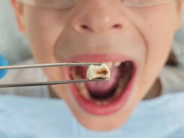 Best Emergency Treatment for Dental Infections or Abscesses in Elmwood Place, OH
